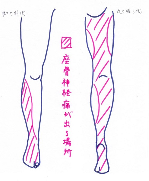 柏市　坐骨神経痛